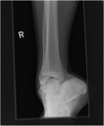 Subtalar Dislocation Xray 2